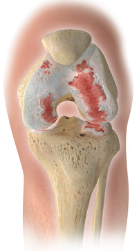 Colored Image of Knee