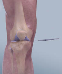 Injecting in a knee