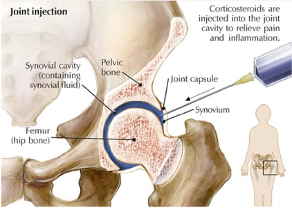 Illustration Image of Injecting in Joint