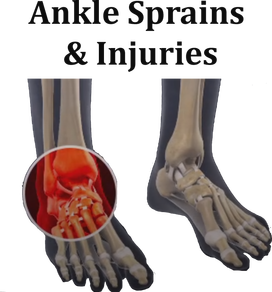 Ankle Sprains and Injuries